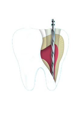 Root Canal Treatment