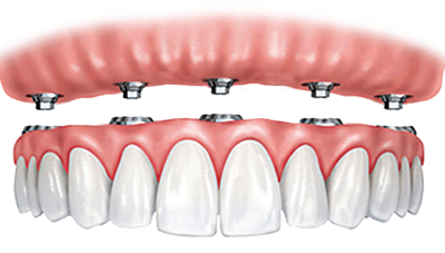 Full Porcelain Crowns